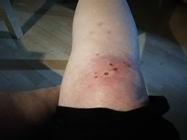 What's the worst sting or bite you've ever had?