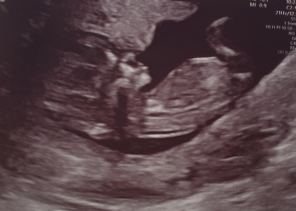 12 week scan - boy or girl?