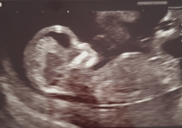 Pregnant After MMC - Thread 2