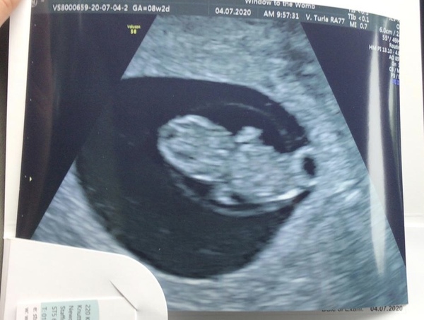 Show me your 7 week scan photos
