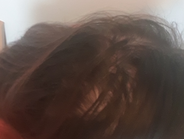 Hair significantly thinning on my crown - help!