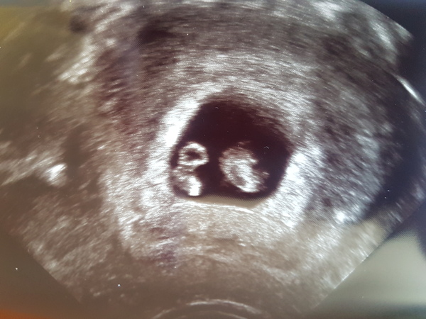 BFP through IVF. Thread to calm the nerves!