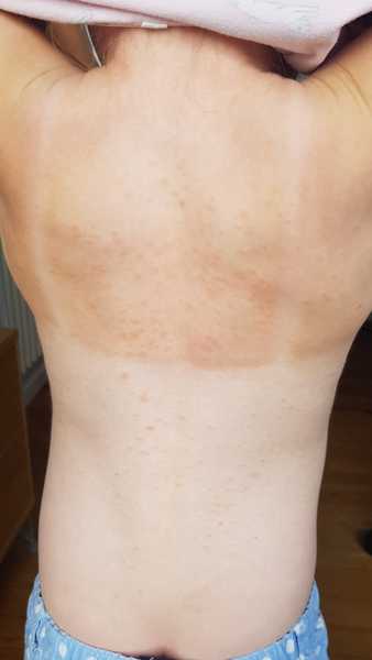 Rash on 6 year old