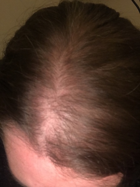Seriously struggling with hairloss...