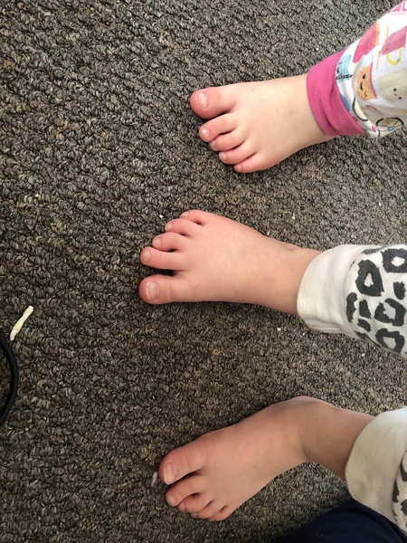 Should I be concerned about my toddlers turnt toes ?