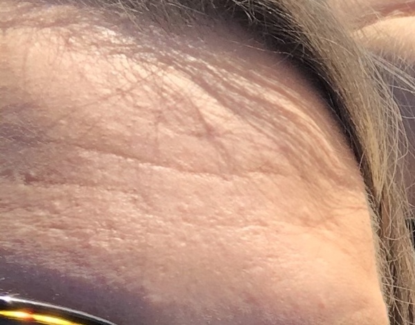 Is Botox my only hope?