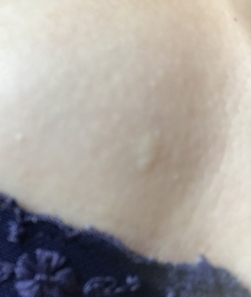 Lump on boob as opposed to in boob...