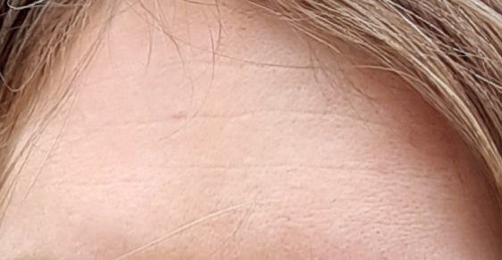 Is 33 too young for botox?