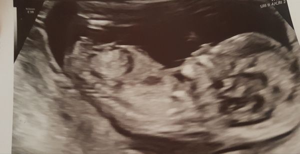 Guess the sex 13 week scan