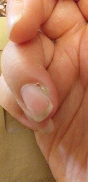 Infected finger
