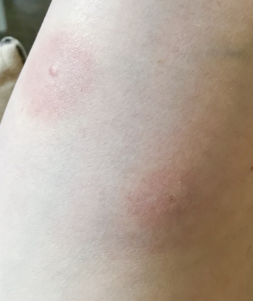 AIBU to think this is not a normal midge bite?