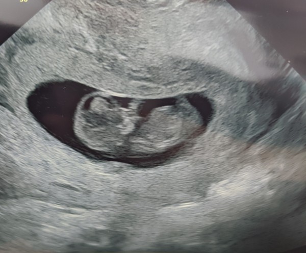 Pregnant after Missed Miscarriage MMC