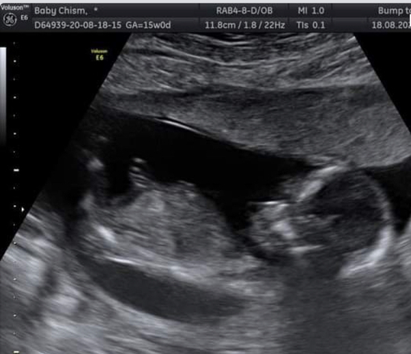 Potty shot / gender scan help