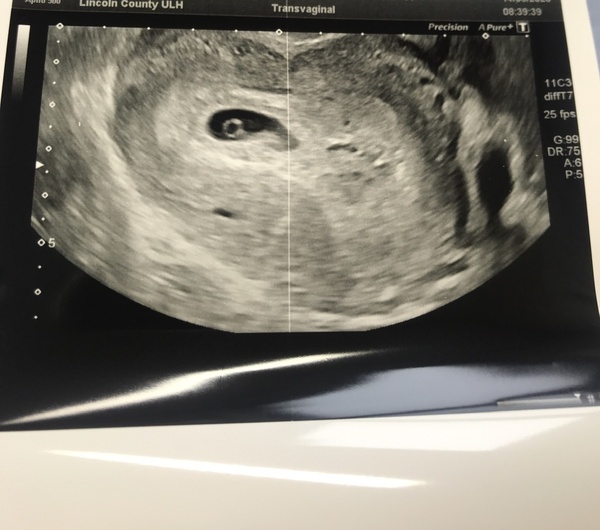 Catching up - ttc after miscarriage part 3