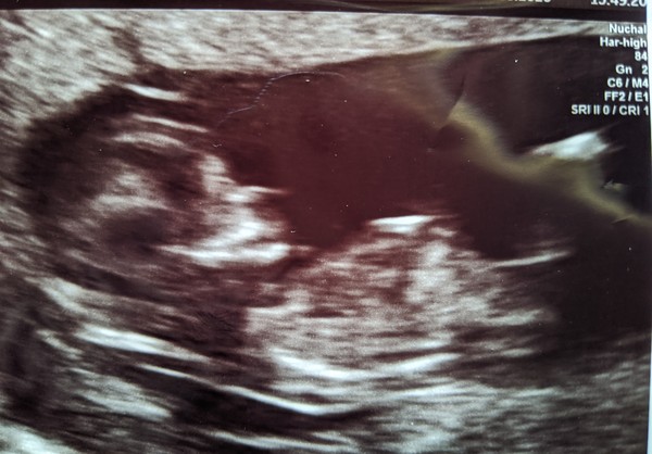 Pregnant After MMC - Thread 2