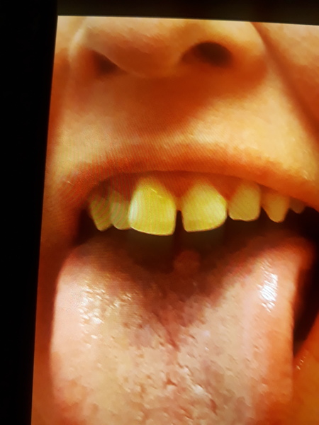 Weird lump on tongue
