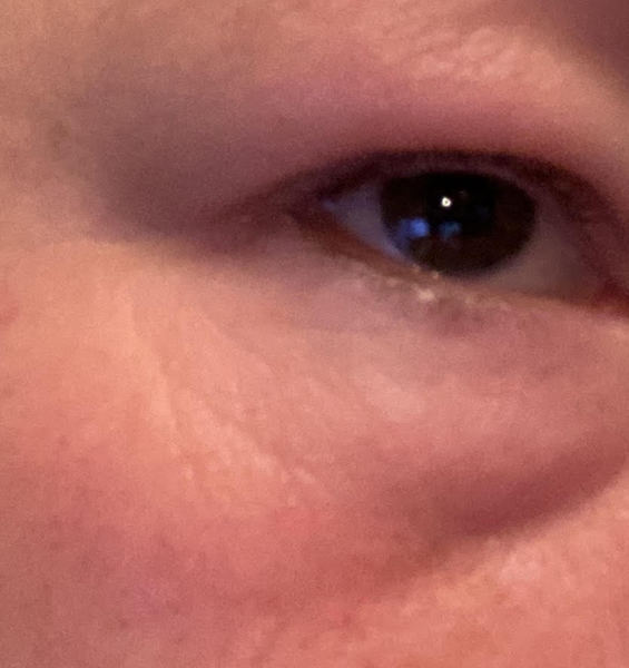 Why have I got these horrible baggy wrinkles instead of normal laugh lines?