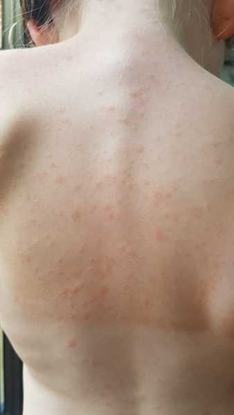 Rash on 6 year old