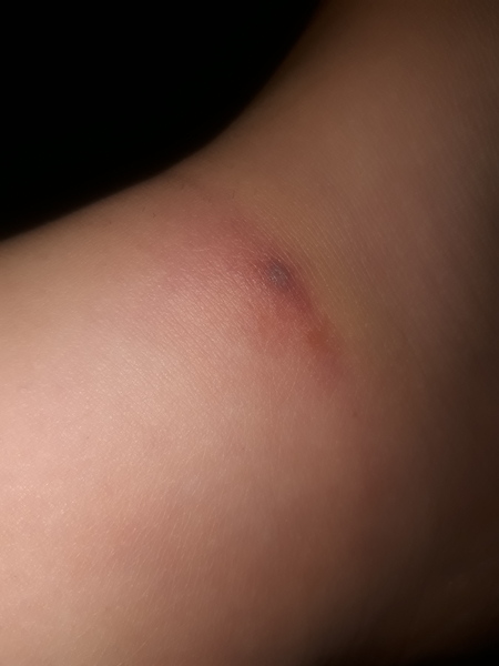Bite turning black..help