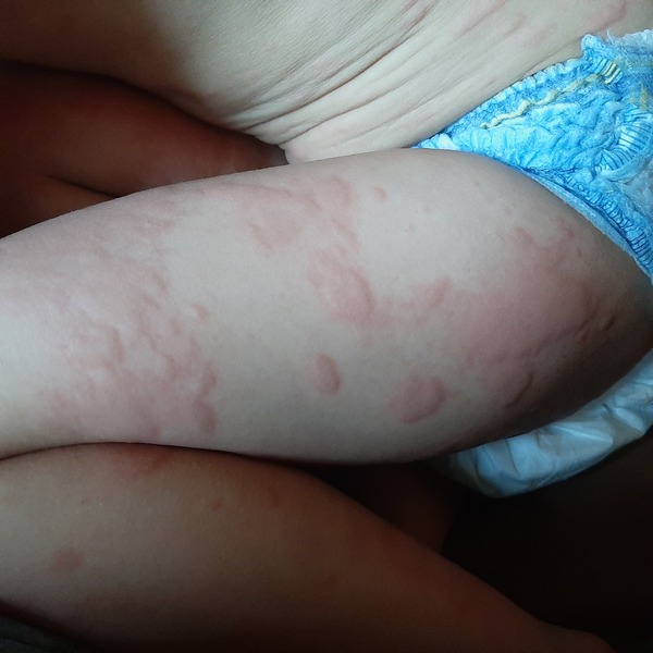 Anyone else have hives with covid?
