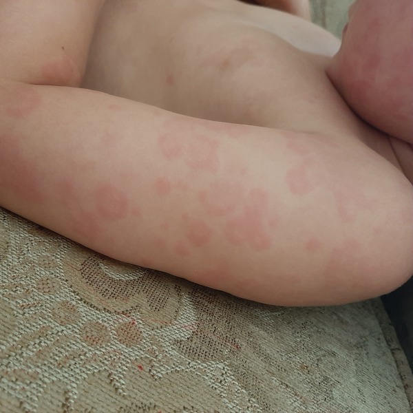 Anyone else have hives with covid?