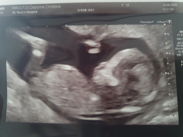 Is it normal my baby's legs are this long?