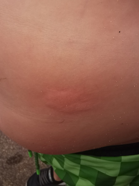 Jelly Fish Sting?