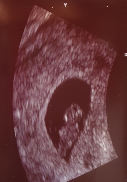 Pregnant After MMC - Thread 2