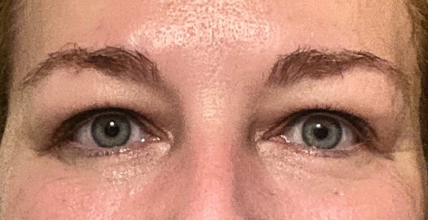 Tear Trough fillers?