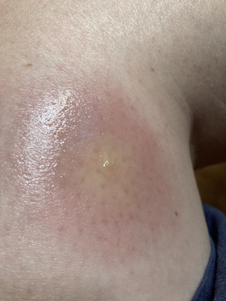 What have I been bitten by?
