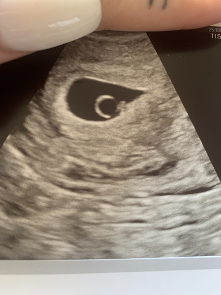 No miscarriage yet but no heartbeat?