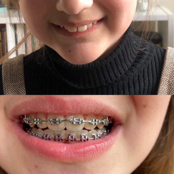 Twin Block Braces - Any Advice?