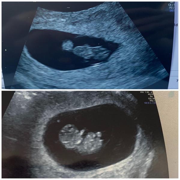 Show me your 7 week scan photos