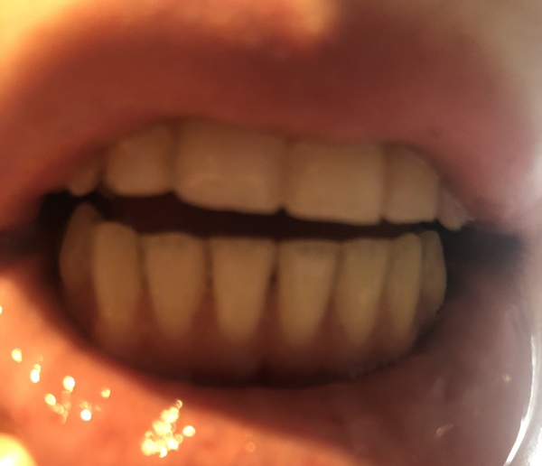 Can't stop thinking about receding gums, I'm terrified - any advice? - Photos inc