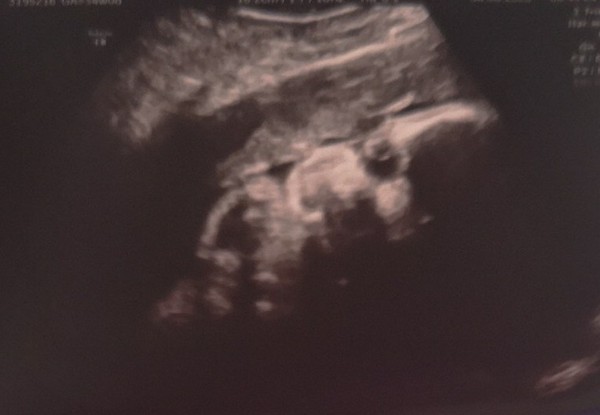 Pregnant after Loss and Dreaming of Rainbows - 5