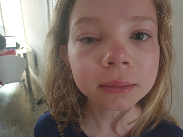 anyone want to guess what is wrong with my daughters eye?