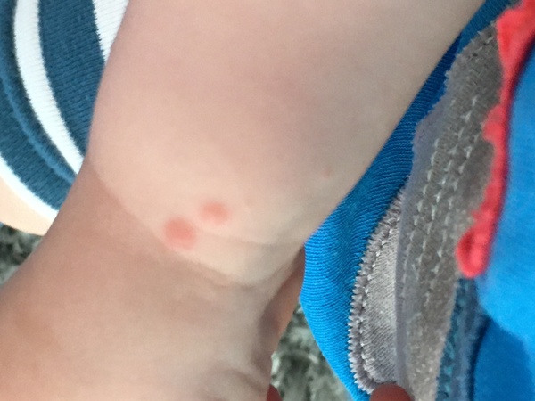 Guess the rash - toddler edition