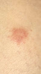 Any GP’s about please? Strange lesion on leg