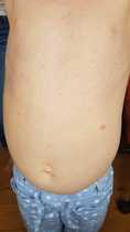 Rash on 6 year old