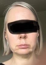 My droopy jowl mini face lift result pics