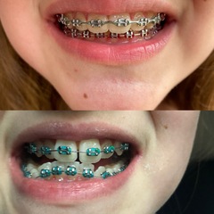 Twin Block Braces - Any Advice?