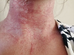 Infected eczema or something else?