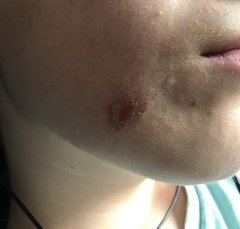 What is this skin sore on DS’s face? Pics attached