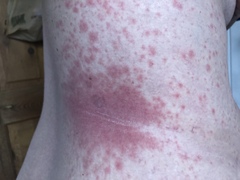 Any idea what this rash may be?
