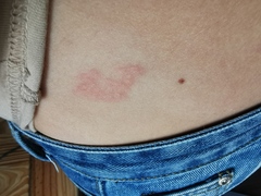 Weird rash in one spot.