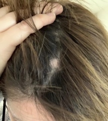 Bald spots on my head