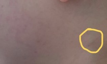 Child rash and node three weeks after Covid-19