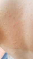 Rash on 6 year old