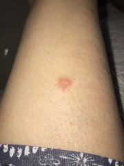 Any GP’s about please? Strange lesion on leg