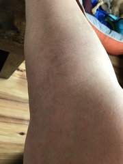 Why are my legs swollen? Pics